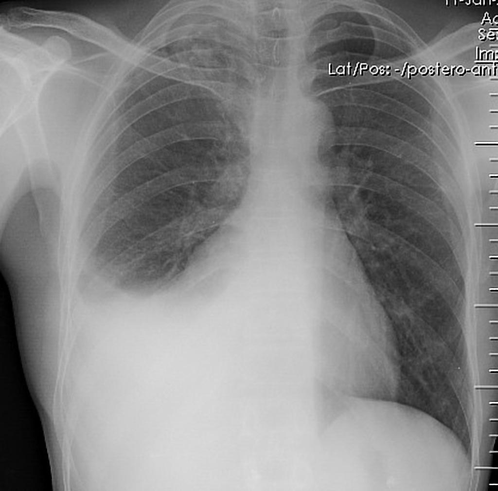 [Sonoanatomy] Lung (rib, pleura, A－line, lung sliding) – POCUS Academy